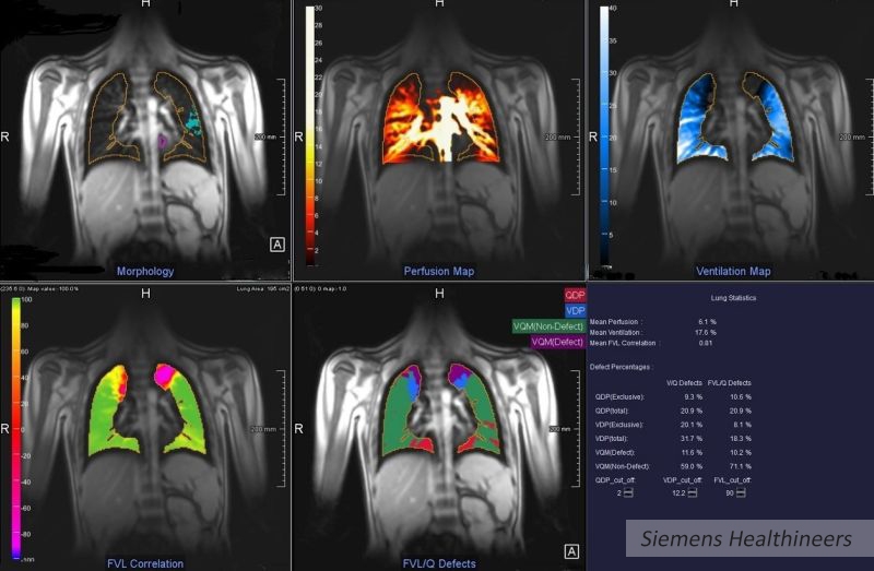 Razem w diagnostyce mukowiscydozy